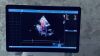 GE Vivid E95 Ultrasound - Cardiac - Vascular