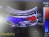 PHILIPS C5-2 Ref 453561224871 Convex Array Ultrasound Transducer